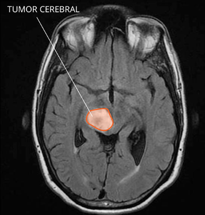 SISTEMA DE DIAGNÓSTICO MÉDICO ASISTIDO BASADO EN INTELIGENCIA ARTIFICIAL PARA EL APOYO MÉDICO EN LA INTERPRETACIÓN DE TOMOGRAFÍAS COMPUTARIZADAS CEREBRALES EN ADULTOS DE 40 A 45 AÑOS.