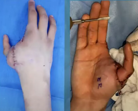 Rehabilitación post pulgarización