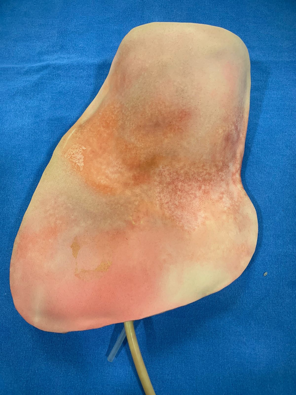 Rediseño de almohadilla para cateterización venosa central de acceso yugular y subclavia de la marca Laerdal