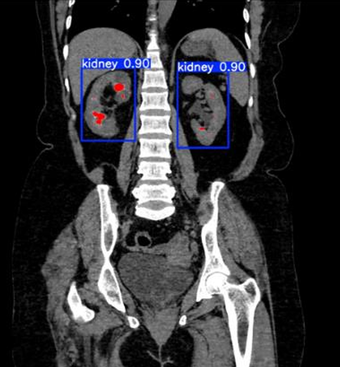 Automated Detection of Renal Calculi in Abdominal Computed Tomography Scans Using Deep Learning Techniques